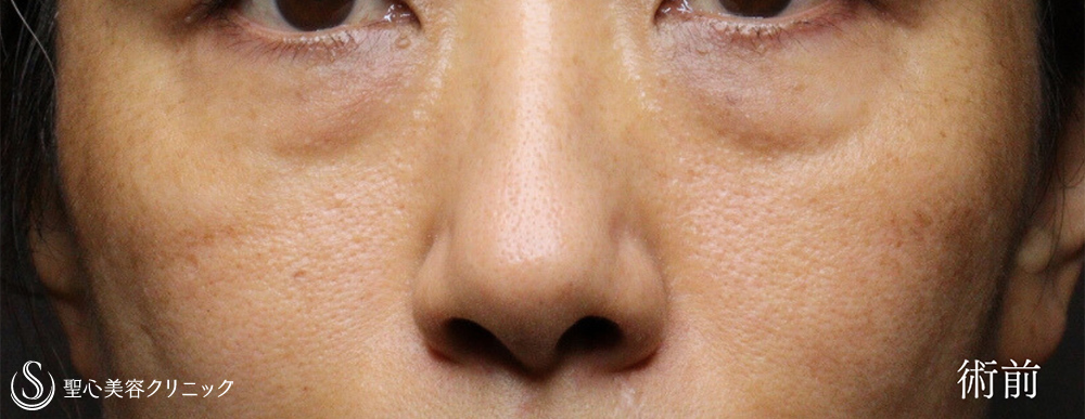 【40代女性・ハムラ法で目の下のクマを劇的に改善】下眼瞼切開術/下眼瞼除皺術/ハムラ法（術後1ヶ月） Before 
