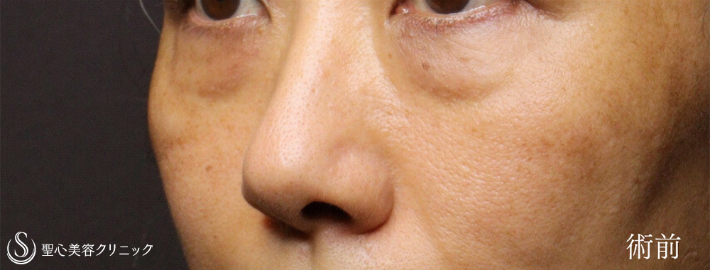 【40代女性・ハムラ法で目の下のクマを劇的に改善】下眼瞼切開術/下眼瞼除皺術/ハムラ法（術後1ヶ月） Before 