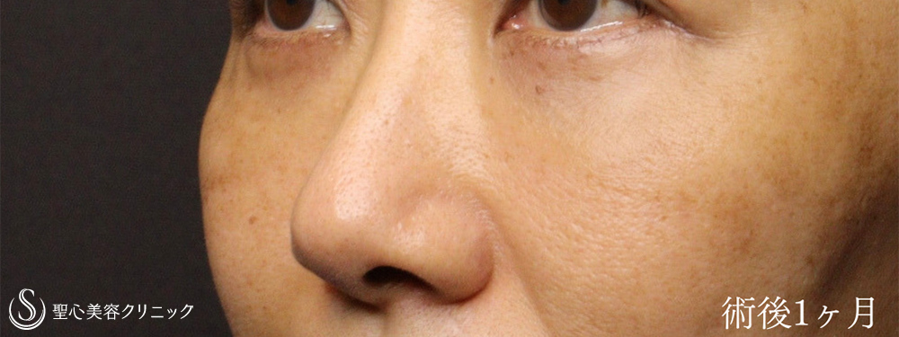 【40代女性・ハムラ法で目の下のクマを劇的に改善】下眼瞼切開術/下眼瞼除皺術/ハムラ法（術後1ヶ月） After 