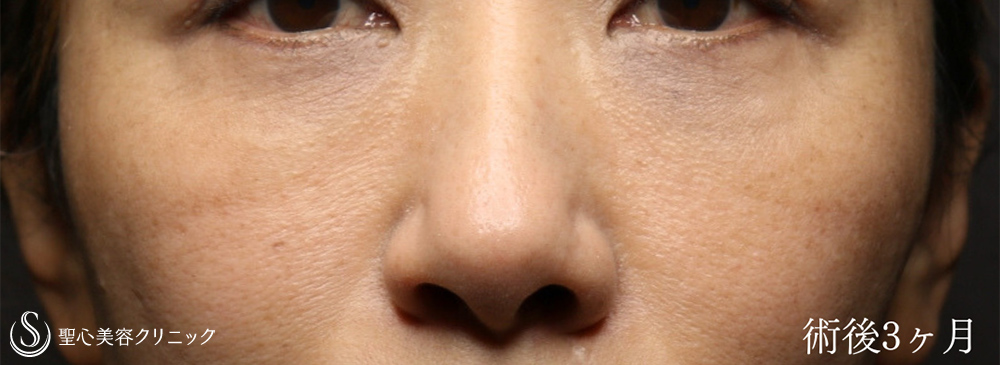 【40代女性・ハムラ法で目の下のクマを劇的に改善】下眼瞼切開術/下眼瞼除皺術/ハムラ法（術後1ヶ月） After 