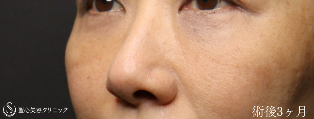 【40代女性・ハムラ法で目の下のクマを劇的に改善】下眼瞼切開術/下眼瞼除皺術/ハムラ法（術後1ヶ月） After 