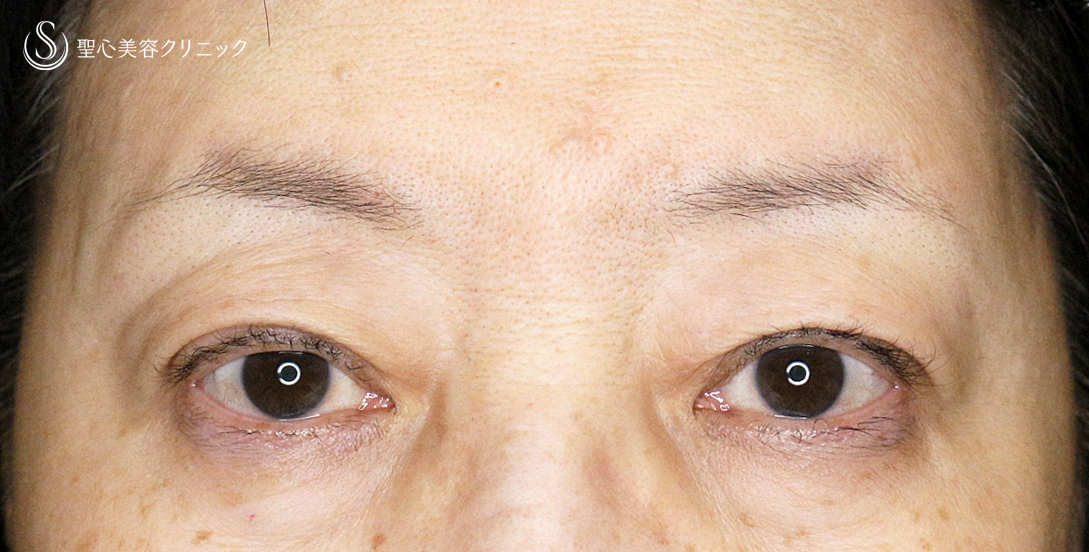 【60代女性・ハードコンタクトによる眼瞼下垂】切らない眼瞼下垂+α法（術直後〜1年後） After 
