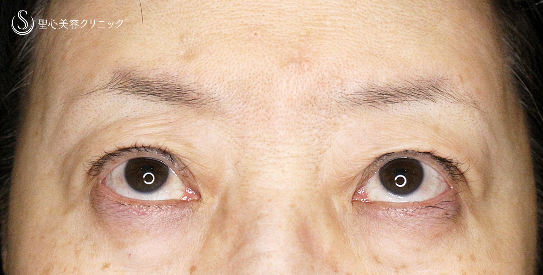 【60代女性・ハードコンタクトによる眼瞼下垂】切らない眼瞼下垂+α法（術直後〜1年後） After 