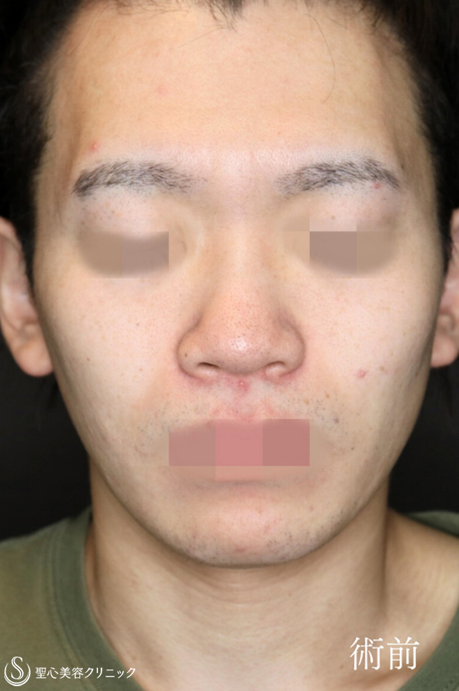 【20代男性・鼻複合手術で忘れ鼻に】鼻尖縮小＋鼻尖形成（耳介軟骨移植）＋小鼻縮小（術後1ヶ月） Before 
