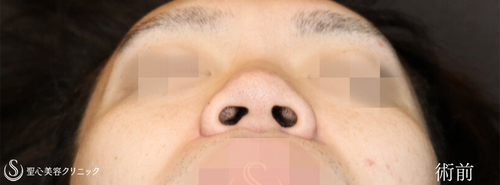【20代男性・鼻複合手術で忘れ鼻に】鼻尖縮小＋鼻尖形成（耳介軟骨移植）＋小鼻縮小（術後1ヶ月） Before 