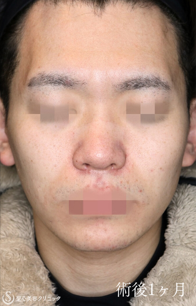 【20代男性・鼻複合手術で忘れ鼻に】鼻尖縮小＋鼻尖形成（耳介軟骨移植）＋小鼻縮小（術後1ヶ月） After 