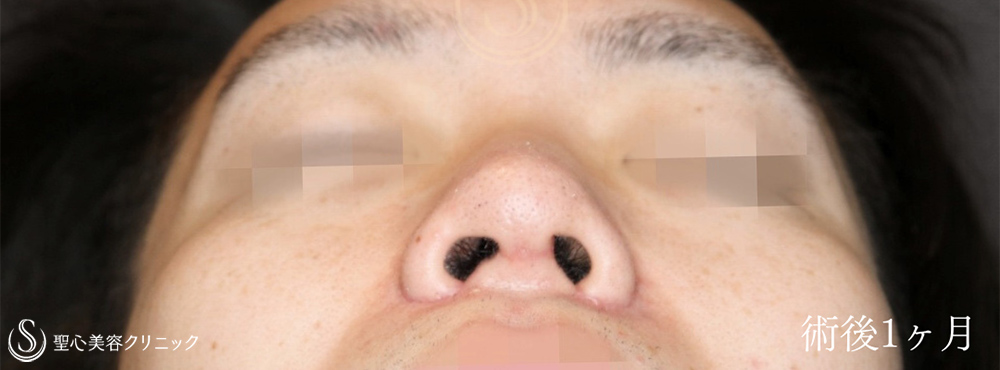 【20代男性・鼻複合手術で忘れ鼻に】鼻尖縮小＋鼻尖形成（耳介軟骨移植）＋小鼻縮小（術後1ヶ月） After 