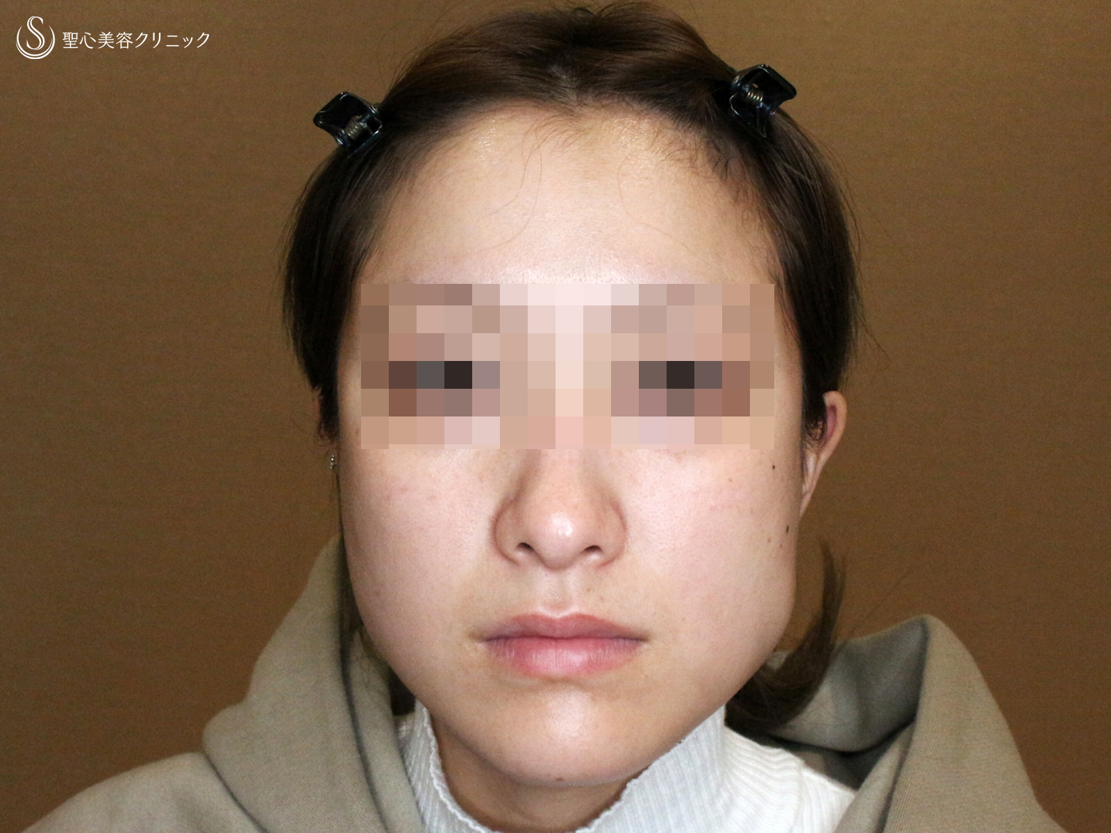 【20代女性・劇的な変化】エラボトックス（3回処置→7ヶ月後） Before 