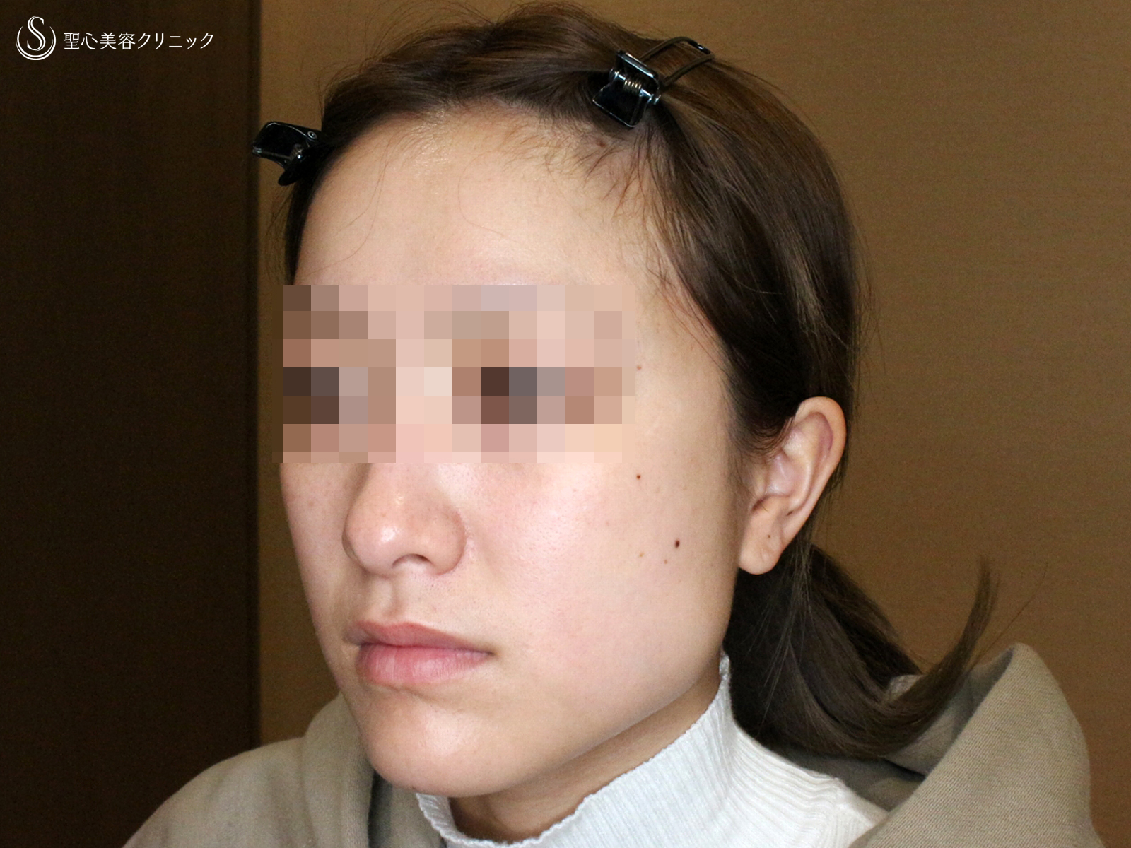 【20代女性・劇的な変化】エラボトックス（3回処置→7ヶ月後） Before 