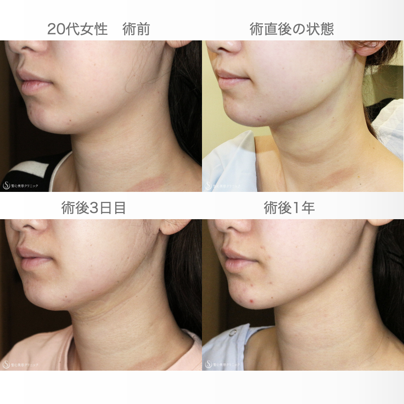 【20代女性・フェイスラインを美しく】ベイザー脂肪吸引「あご下」（術直後〜1年後） After 
