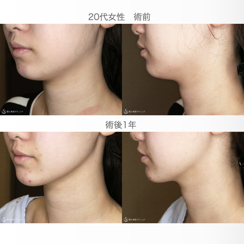【20代女性・フェイスラインを美しく】ベイザー脂肪吸引「あご下」（術直後〜1年後） After 