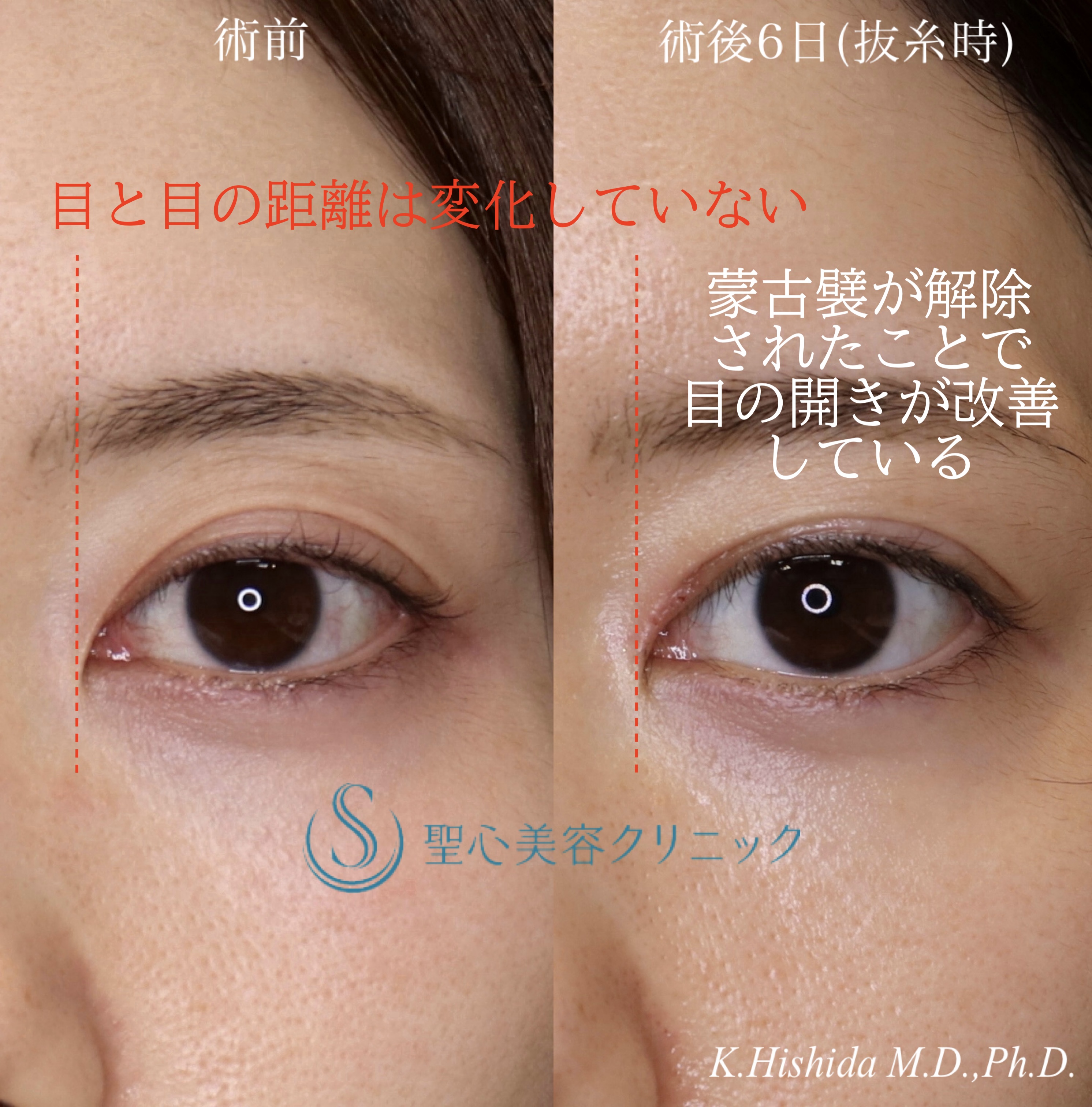 【20代女性・寄り目にさせず目頭側まで二重を入れたい！！】目上切開・修正（術後6日（抜糸時）） After 