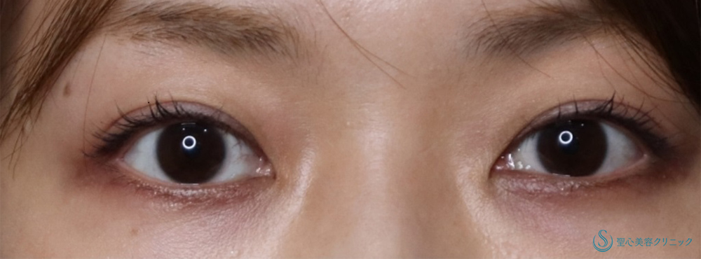 【30代女性・目頭切開で自然に目を拡大】目頭切開/目上切開（術後3ヶ月） Before 