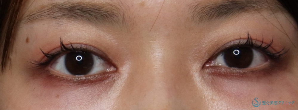 【30代女性・目頭切開で自然に目を拡大】目頭切開/目上切開（術後3ヶ月） After 