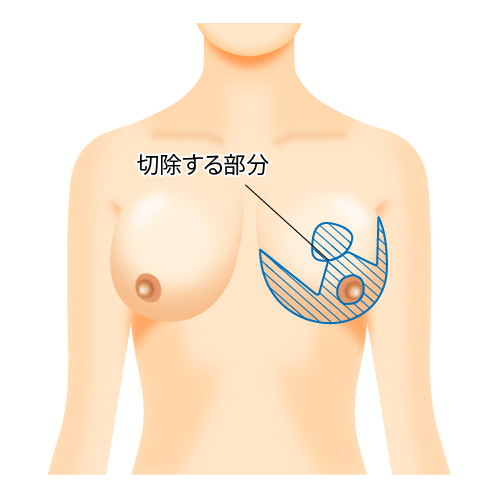 切開、縫合部分