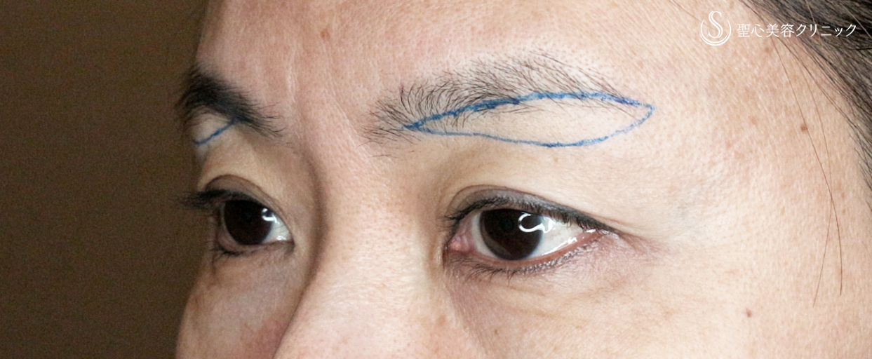 【50代女性・20年前の二重ラインに若返る】眉下リフト+α「Ver.1」単独（術直後〜2年後） Before 