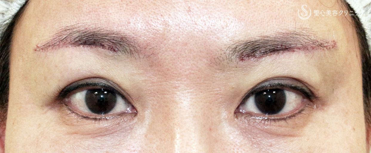 【50代女性・20年前の二重ラインに若返る】眉下リフト+α「Ver.1」単独（術直後〜2年後） After 