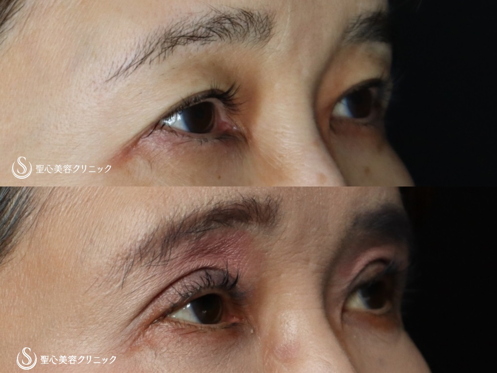 【50代女性・まぶたのたるみを取ってパッチリ二重に】重瞼線部分開法（術後6ヶ月） After 