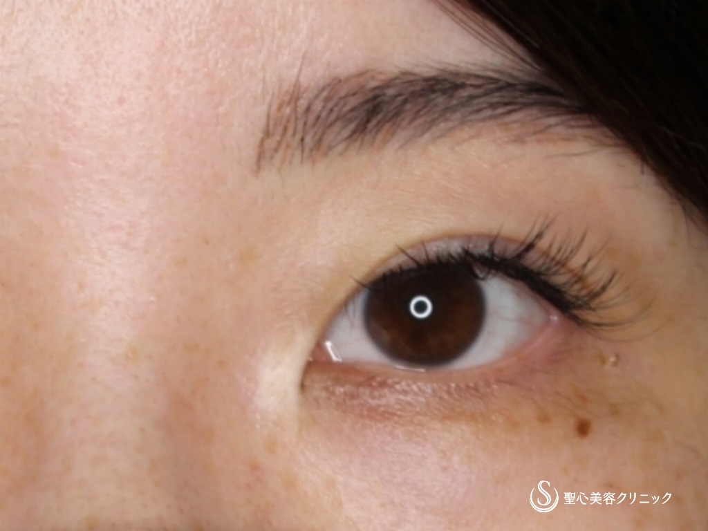 【30代女性・目頭切開で自然に目を拡大】目頭切開＋二重術（切開法）・他院修正（術後半年） Before 