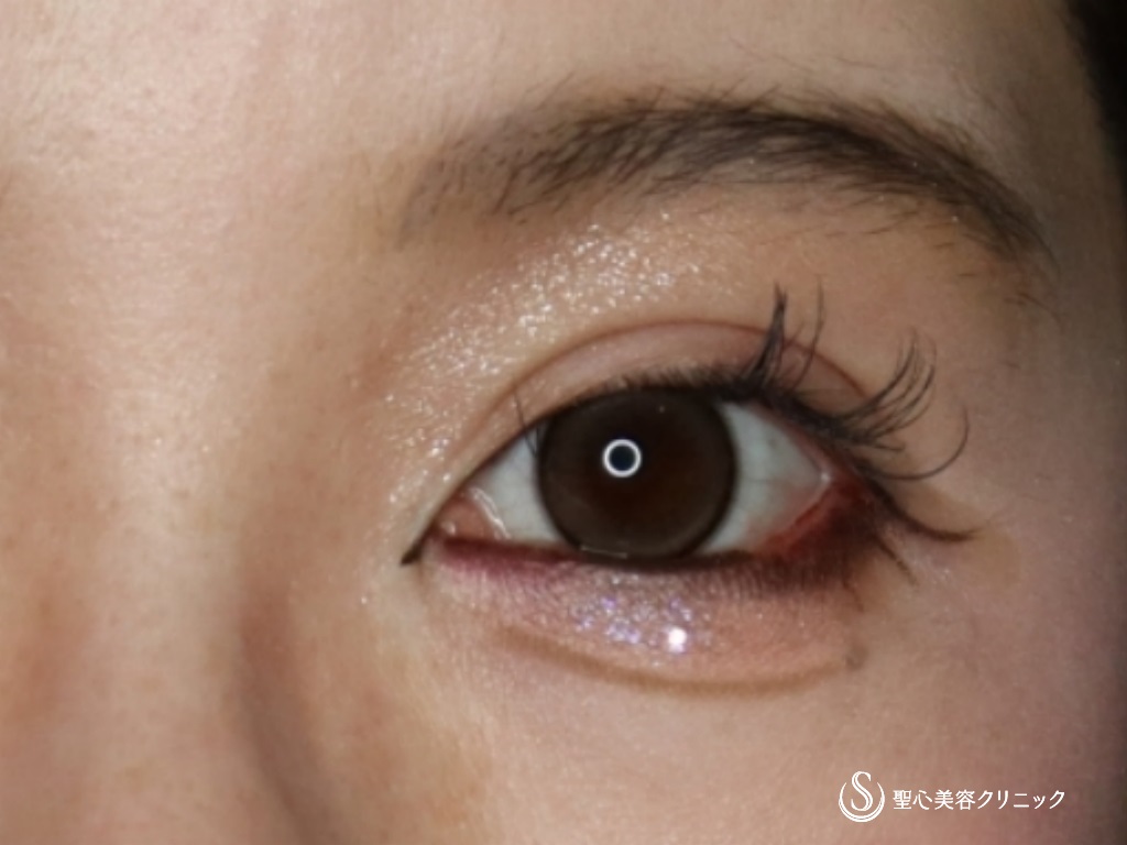 【30代女性・目頭切開で自然に目を拡大】目頭切開＋二重術（切開法）・他院修正（術後半年） After 