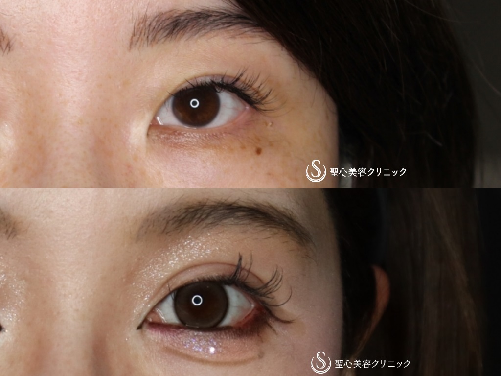【30代女性・目頭切開で自然に目を拡大】目頭切開＋二重術（切開法）・他院修正（術後半年） After 