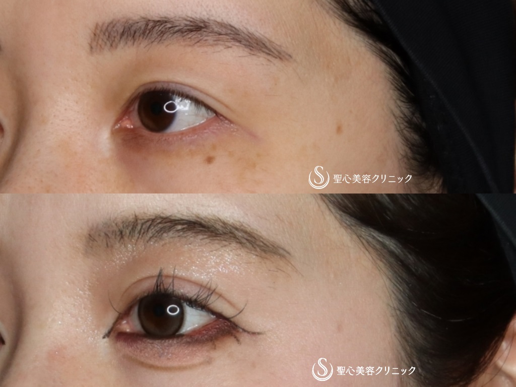 【30代女性・目頭切開で自然に目を拡大】目頭切開＋二重術（切開法）・他院修正（術後半年） After 