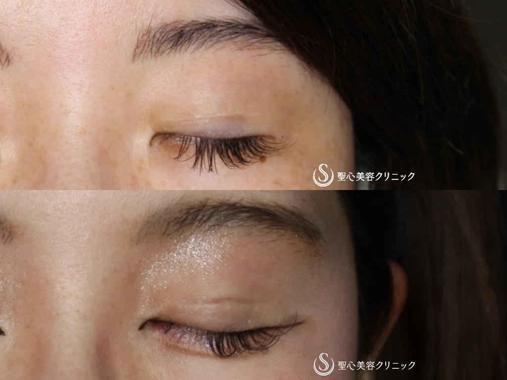 【30代女性・目頭切開で自然に目を拡大】目頭切開＋二重術（切開法）・他院修正（術後半年） After 