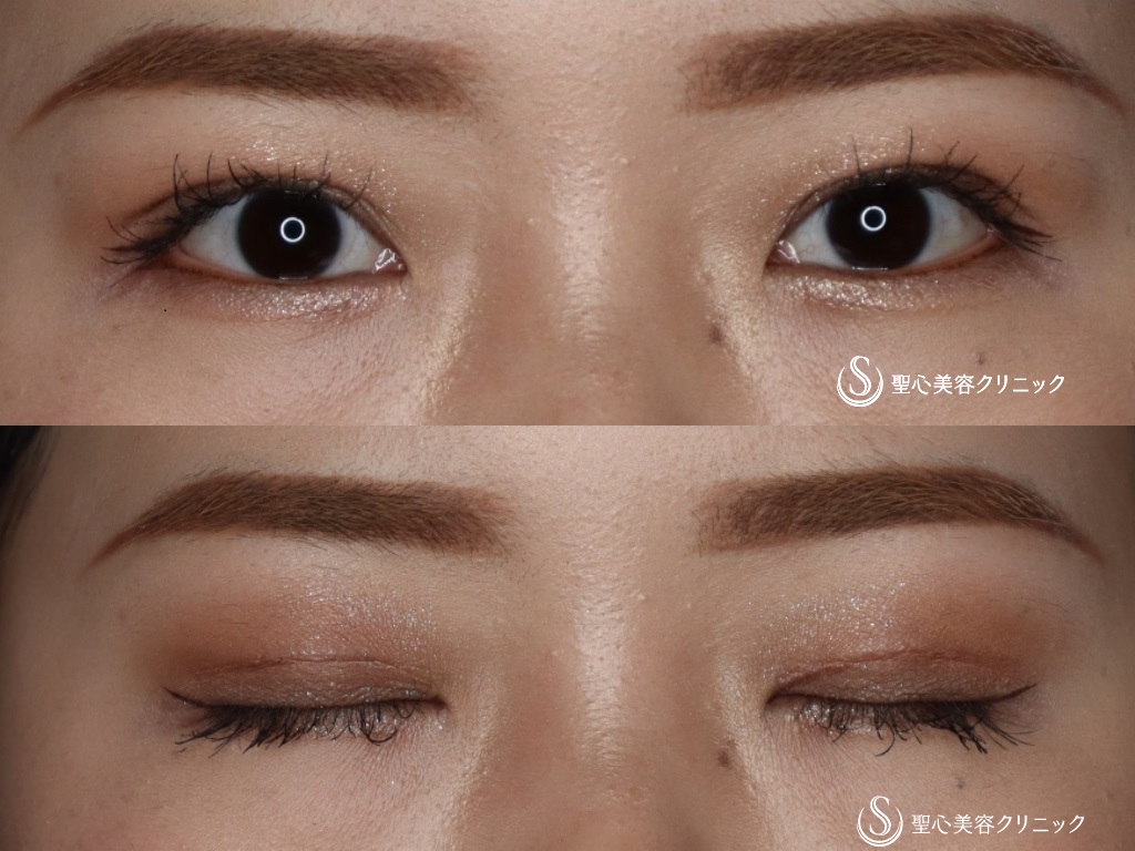 【20代女性・二重切開でスッキリ二重に】二重術（切開法）＋眼窩脱脂（術後1ヶ月） After 