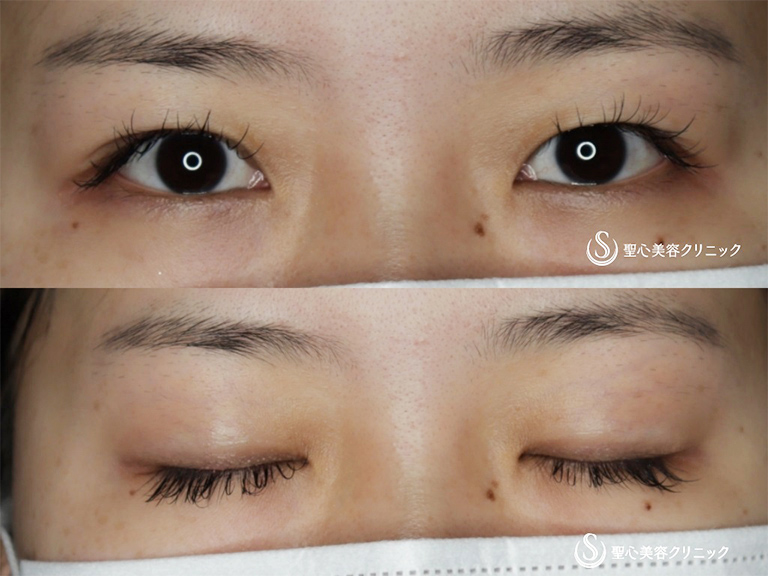 【20代女性・二重切開でスッキリ二重に】二重術（切開法）＋眼窩脱脂（術後1ヶ月） Before 