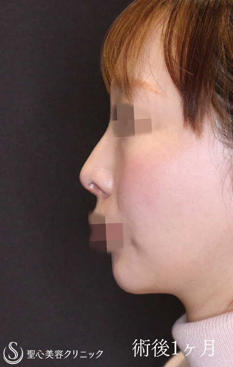【20代女性・鼻中隔延長でACRを整え美人鼻に】鼻中隔延長術＋鼻尖縮小＋鷲鼻修正（術後1ヶ月） After 