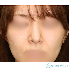 【30代女性・美しいシャープな小鼻】小鼻縮小（術後2ヶ月） Before 