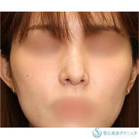 【30代女性・美しいシャープな小鼻】小鼻縮小（術後2ヶ月） After 