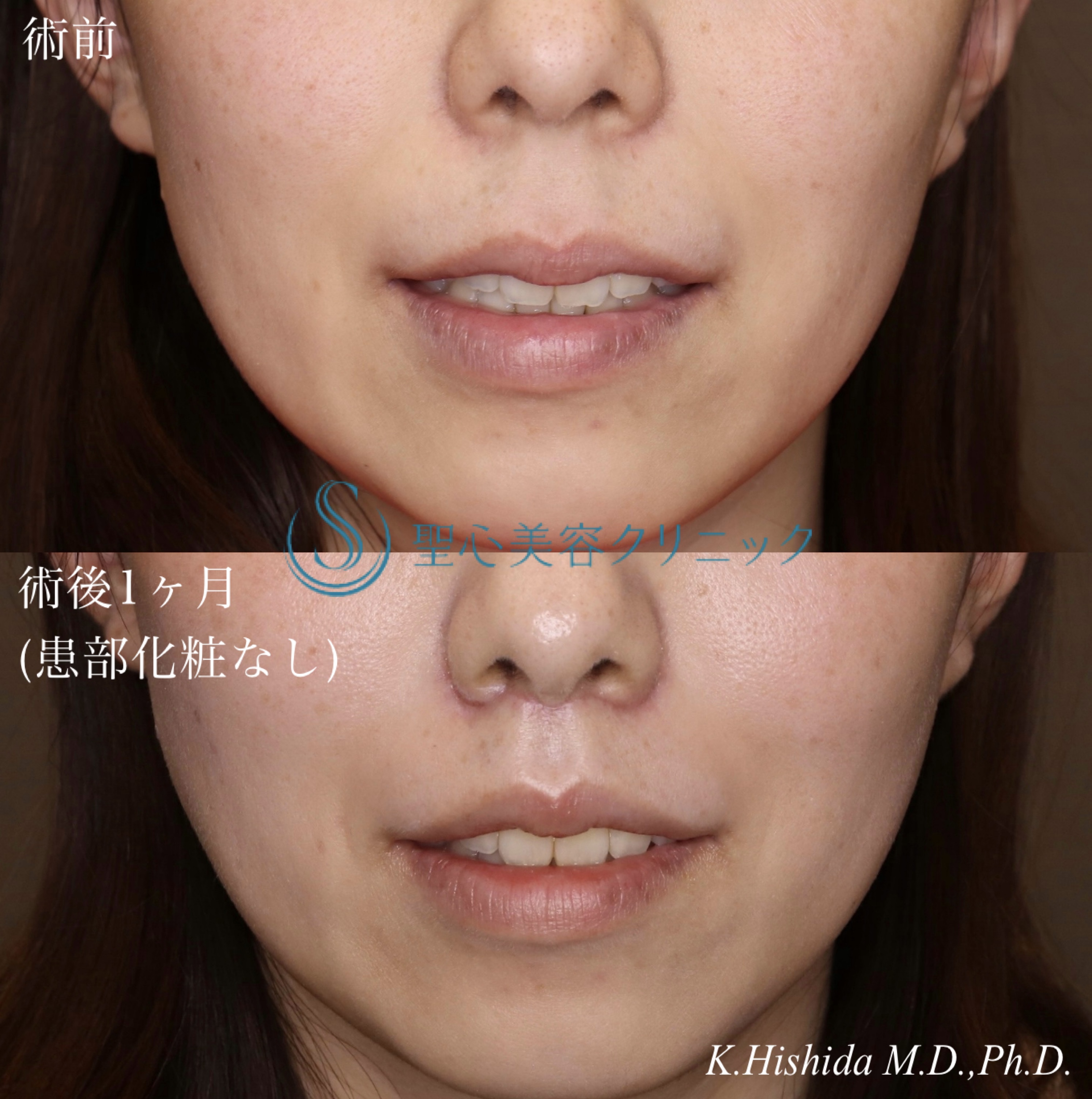 【30代女性・人中を短くしたい！！】プレミアムリップリフト（プレミアム人中短縮術）（術後1ヶ月） After 