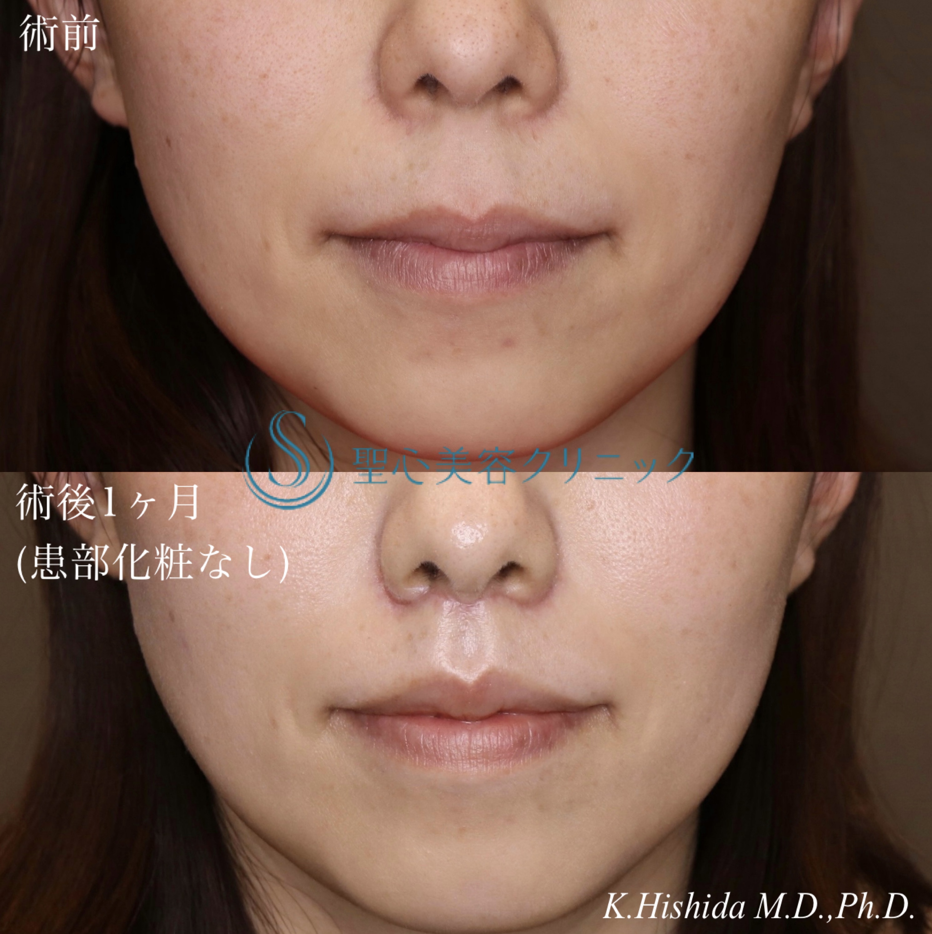 【30代女性・人中を短くしたい！！】プレミアムリップリフト（プレミアム人中短縮術）（術後1ヶ月） After 