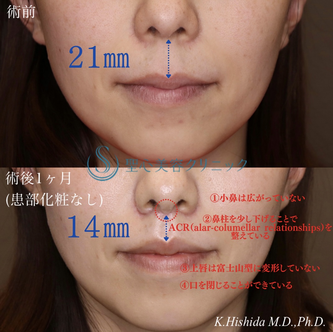 【30代女性・人中を短くしたい！！】プレミアムリップリフト（プレミアム人中短縮術）（術後1ヶ月） After 