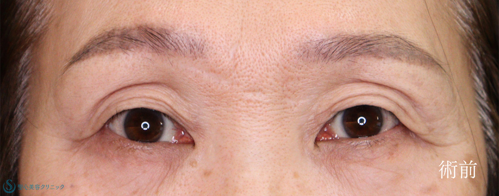 【60代女性・埋没法とたるみ取りで目元をスッキリ】二重術（埋没法）：マイクロメソッド+α＋眉下切開法（眉下リフト）（術後2ヶ月） Before 