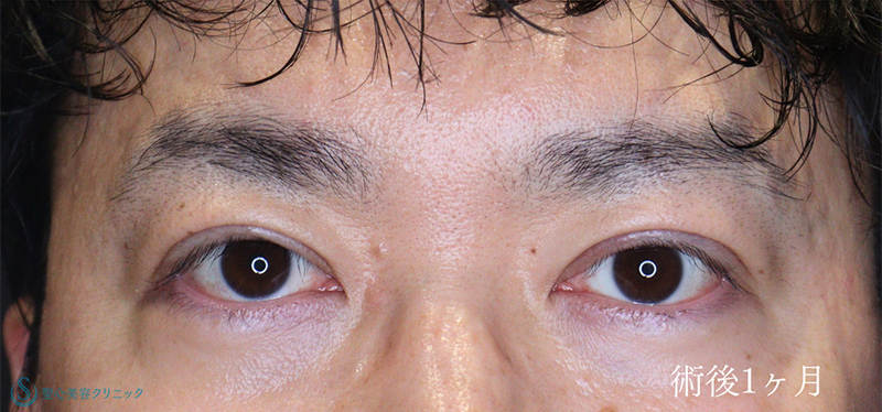 【40代男性・眼瞼下垂でお目元を凛々しく】眼瞼下垂（切開法/腱膜縫縮法）（術後1ヶ月） After 