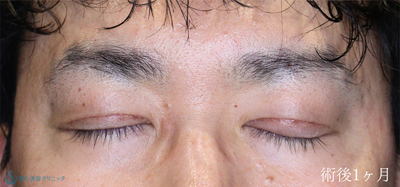 【40代男性・眼瞼下垂でお目元を凛々しく】眼瞼下垂（切開法/腱膜縫縮法）（術後1ヶ月） After 