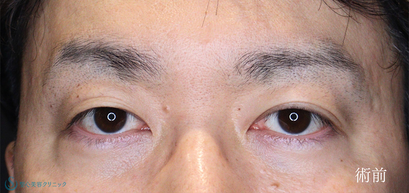 【40代男性・眼瞼下垂でお目元を凛々しく】眼瞼下垂（切開法/腱膜縫縮法）（術後1ヶ月） Before 