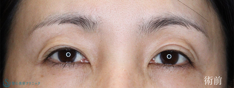 【40代女性・二重の左右差を改善し、お目元を華やかに】マイクロメソッド＋α（二重埋没法）（術後1ヶ月） Before 