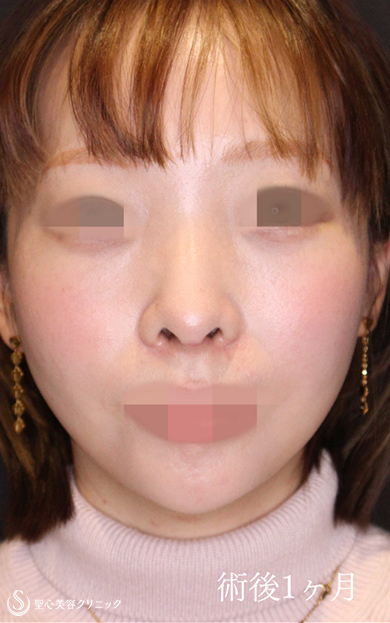 【20代女性・鼻中隔延長でACRを整え美人鼻に】鼻中隔延長術＋鼻尖縮小＋鷲鼻修正（術後1ヶ月） After 