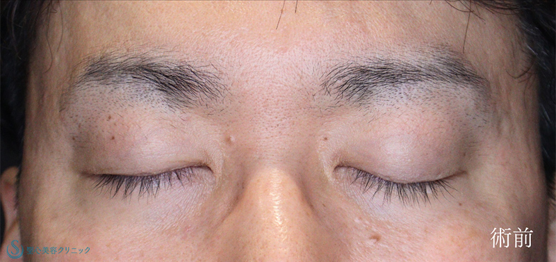 【40代男性・眼瞼下垂でお目元を凛々しく】眼瞼下垂（切開法/腱膜縫縮法）（術後1ヶ月） Before 