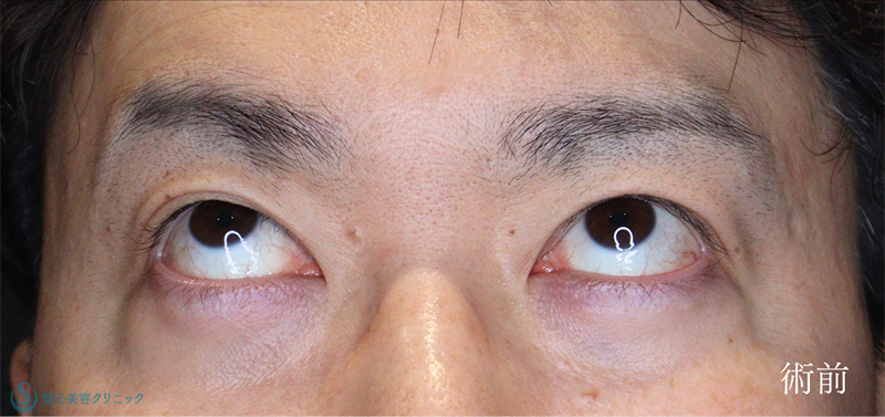 【40代男性・眼瞼下垂でお目元を凛々しく】眼瞼下垂（切開法/腱膜縫縮法）（術後1ヶ月） Before 