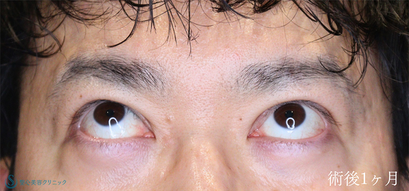 【40代男性・眼瞼下垂でお目元を凛々しく】眼瞼下垂（切開法/腱膜縫縮法）（術後1ヶ月） After 