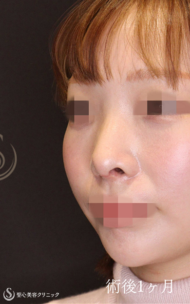 【20代女性・鼻中隔延長でACRを整え美人鼻に】鼻中隔延長術＋鼻尖縮小＋鷲鼻修正（術後1ヶ月） After 