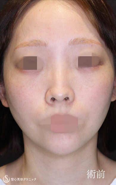【20代女性・鼻中隔延長でACRを整え美人鼻に】鼻中隔延長術＋鼻尖縮小＋鷲鼻修正（術後1ヶ月） Before 