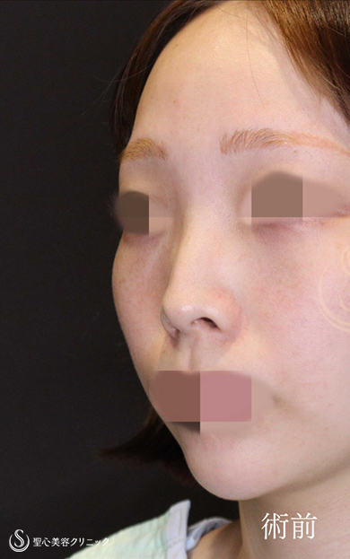【20代女性・鼻中隔延長でACRを整え美人鼻に】鼻中隔延長術＋鼻尖縮小＋鷲鼻修正（術後1ヶ月） Before 