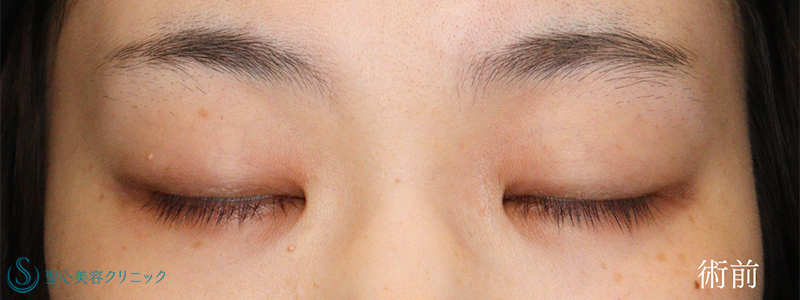 【20代女性・目頭切開と埋没法で華やかなお目元に】二重術（埋没法）：マイクロメソッド+α＋目頭切開/目上切開（術後1ヶ月） Before 