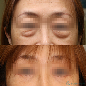 【50代女性・目の下のたるみをスッキリ】下眼瞼切開術/下眼瞼除皺術/ハムラ法（術後1ヶ月） After 