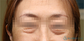 【50代女性・目の下のたるみをスッキリ】下眼瞼切開術/下眼瞼除皺術/ハムラ法（術後1ヶ月） Before 